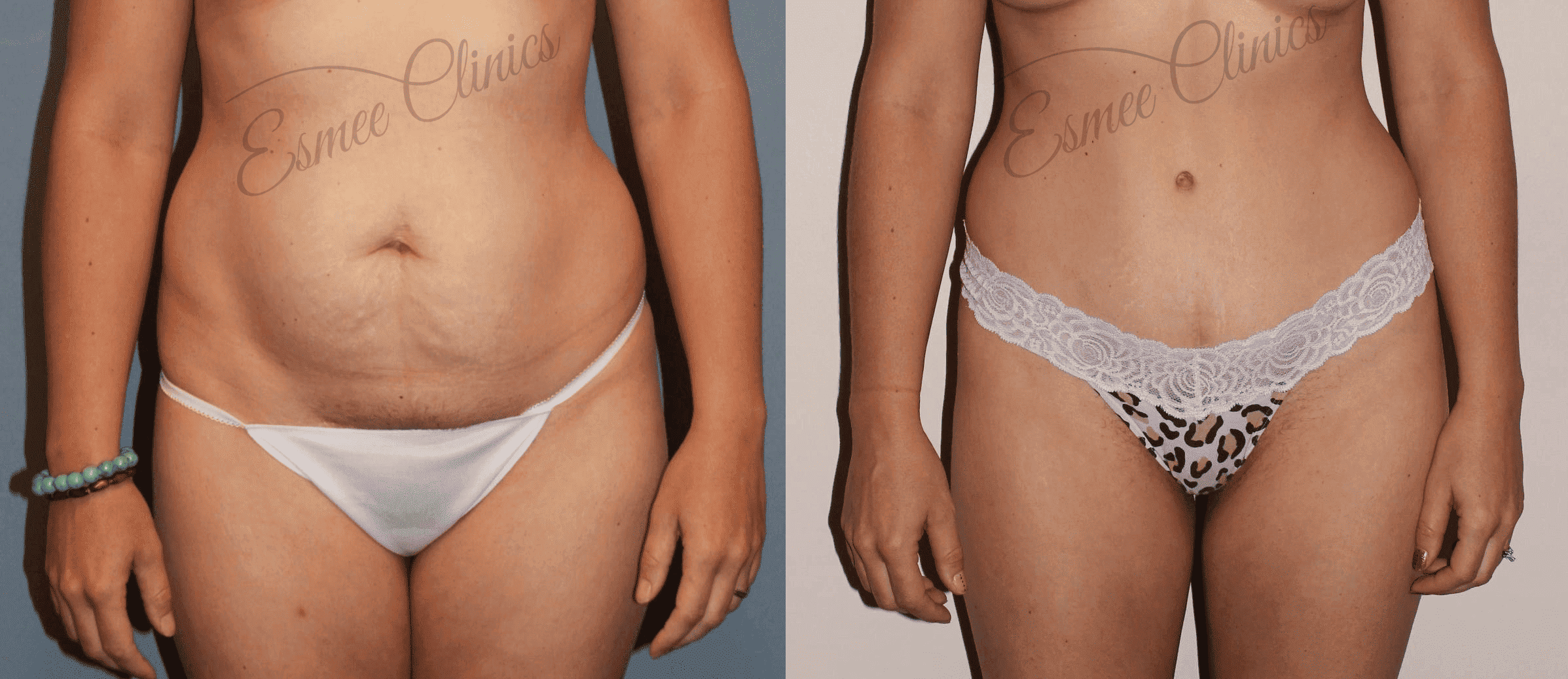 Before and After img